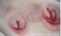刺血拔罐疗法视频,传统中医疗法的现代演绎